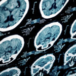 Hidden Symptoms of Brain Injuries