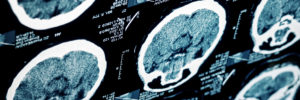 Hidden Symptoms of Brain Injuries